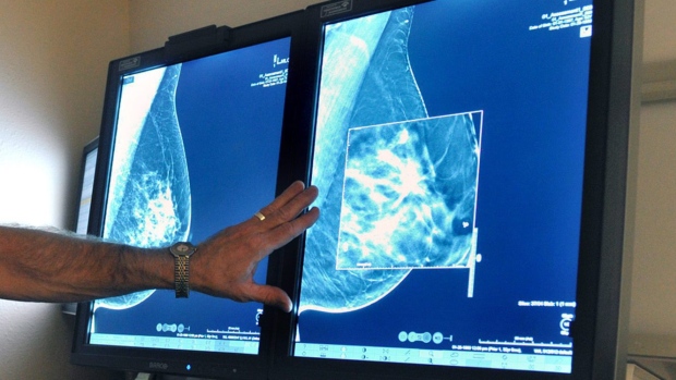 加拿大 BC 省新研究：移民妇女定期检查乳腺癌的比例太低