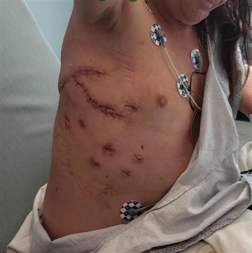 尼尔森在Facebook发布照片显示身体右侧的伤口缝线。FB图