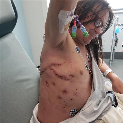 尼尔森身上有多处伤口缝线。FB图