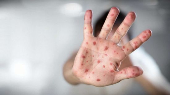 安省首席卫生官警告麻疹“潜在爆发” 两儿童海外旅行后感染！