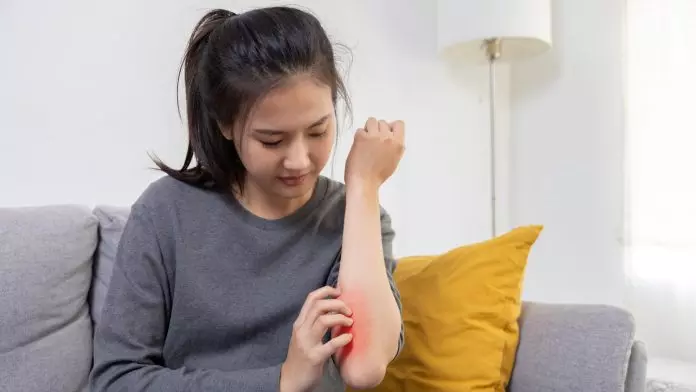 78%荨麻疹由1原因引起 用笔盖可自测患病风险 医生教3招改善病情