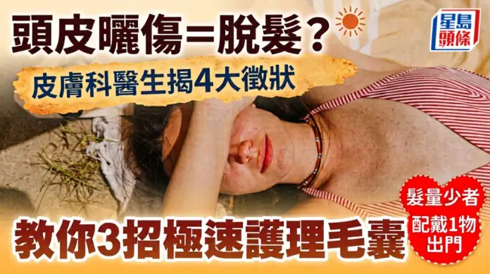 炎热天气头皮晒伤 皮肤科医生揭4大征状 教你3招极速护理毛囊